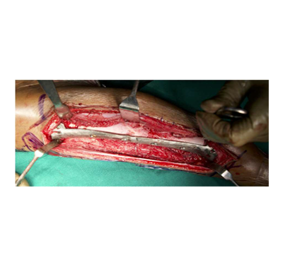 Implantation of femoral implant