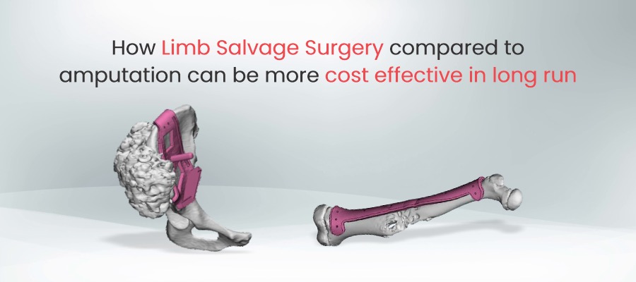 How Limb Salvage Surgery Compared To Amputation Can Be More Cost