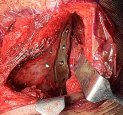 Implantation of Anterior