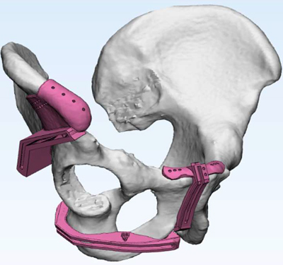  Cutting guide Jigs