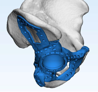 Customized Hip implant Design