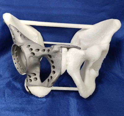  Patient Specific Hip implant