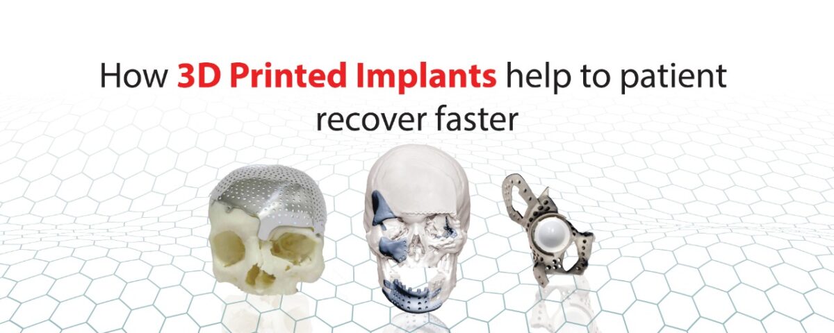 How 3D printed implants help to patient recover faster