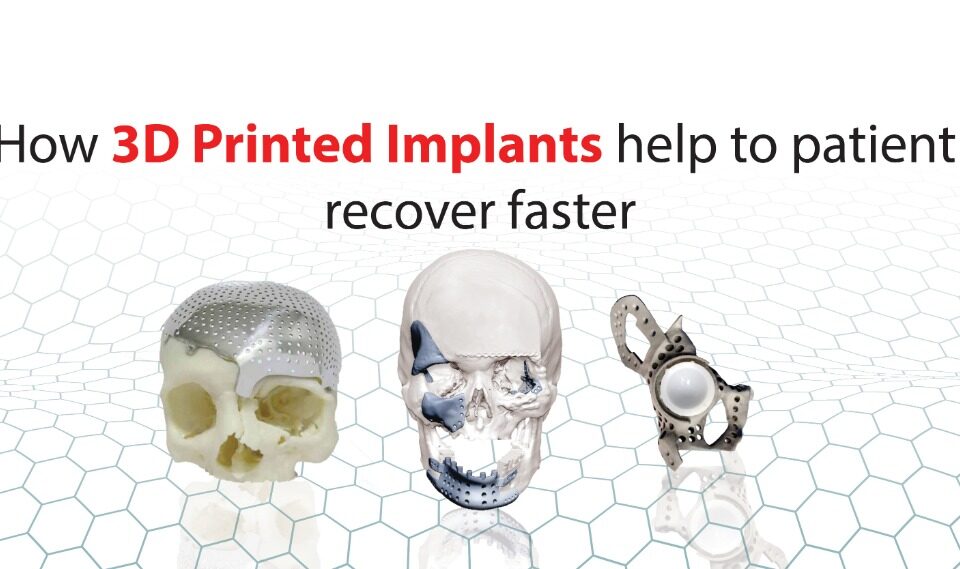 How 3D printed implants help to patient recover faster