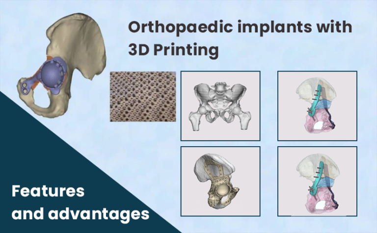 Mandible (Jaw) Implants with 3D Printing (Things you need to know)