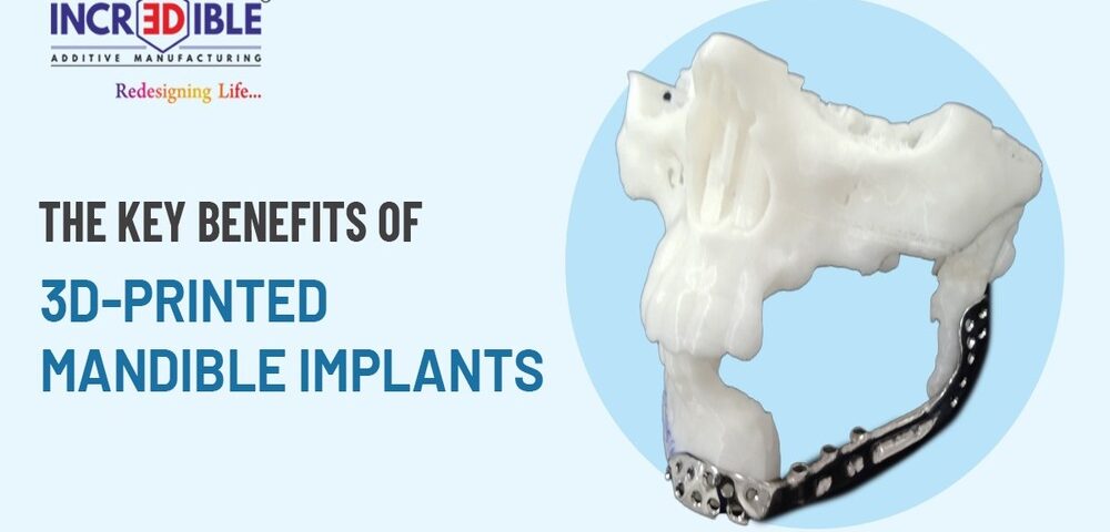 The Key Benefits of 3D-Printed Mandible Implants