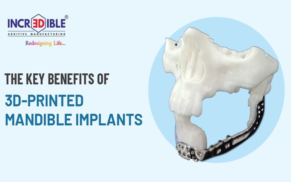 The Key Benefits of 3D-Printed Mandible Implants