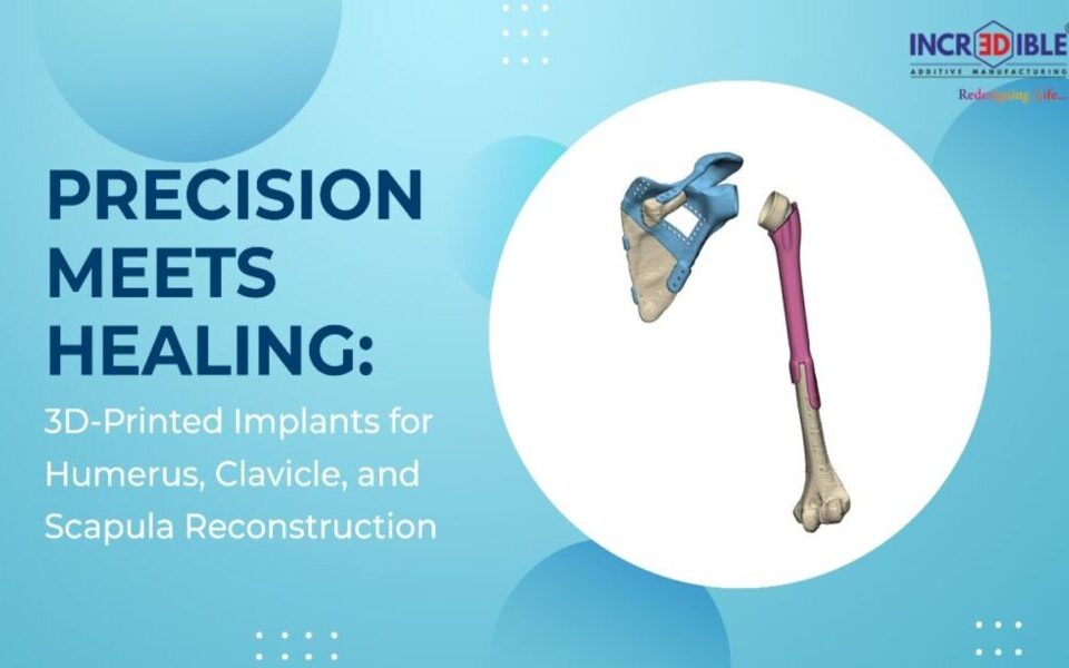 Precision Meets Healing: 3D-Printed Implants for Humerus, Clavicle, and Scapula Reconstruction