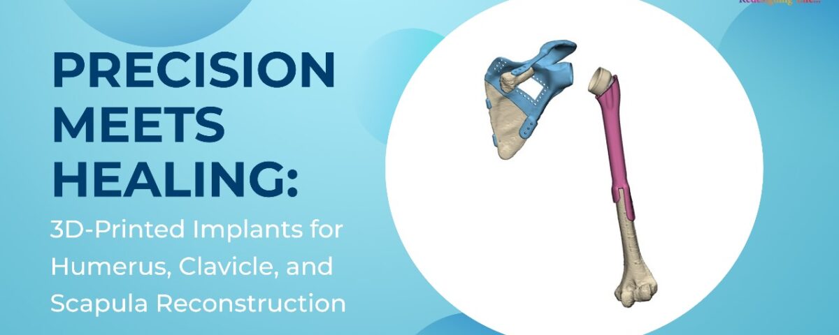 Precision Meets Healing 3D-Printed Implants for Humerus, Clavicle, and Scapula Reconstruction