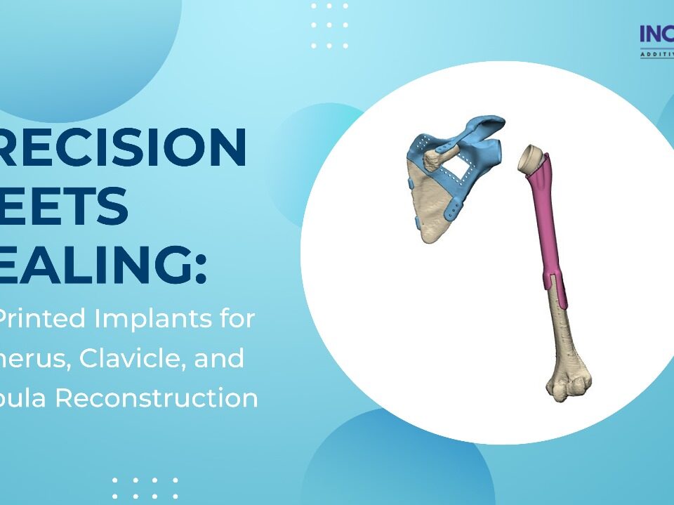 Precision Meets Healing 3D-Printed Implants for Humerus, Clavicle, and Scapula Reconstruction