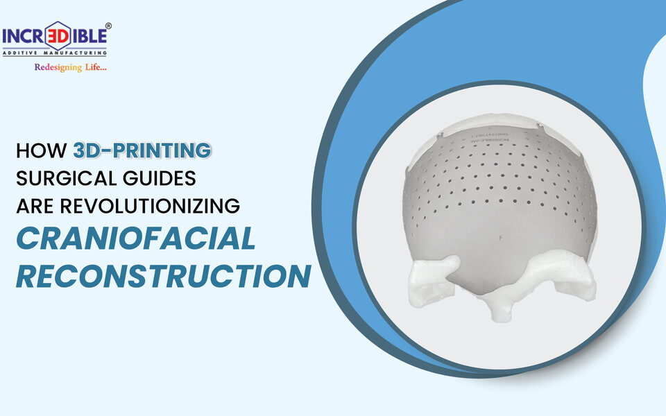 How 3D-Printed Surgical Guides Are Revolutionizing Craniofacial Reconstruction