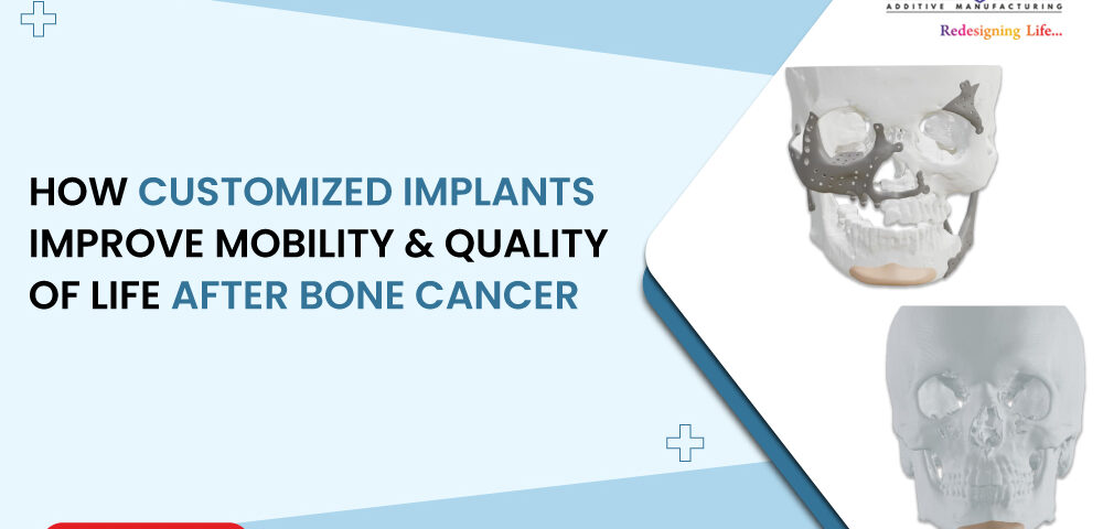 How Customized Implants Improve Mobility and Quality of Life After Bone Cancer