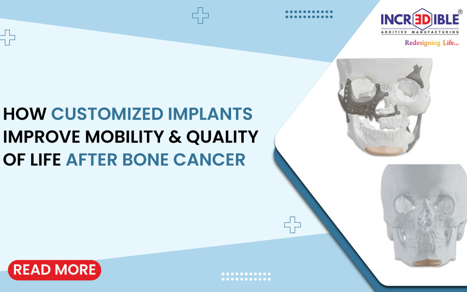 How Customized Implants Improve Mobility and Quality of Life After Bone Cancer