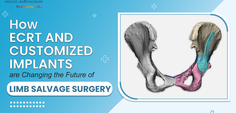 How ECRT and Customized Implants Are Changing the Future of Limb Salvage Surgery