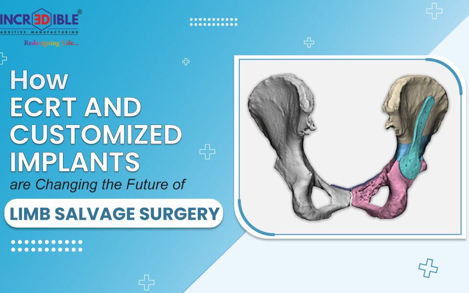 How ECRT and Customized Implants Are Changing the Future of Limb Salvage Surgery