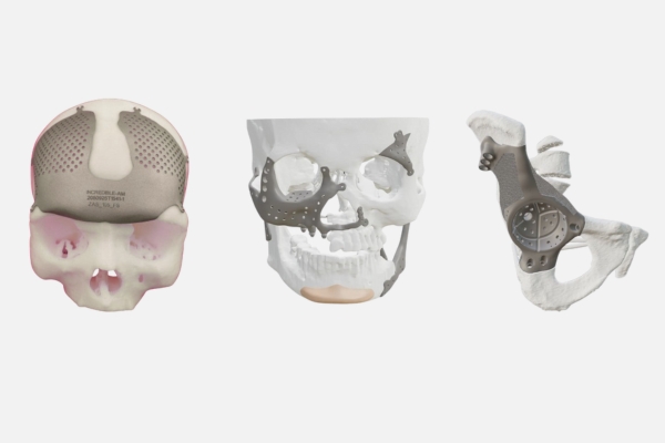 4. 3D Printing in Metal Implants – Custom Designs for Every Patient