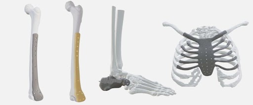3D Printing in Orthopedic Innovation