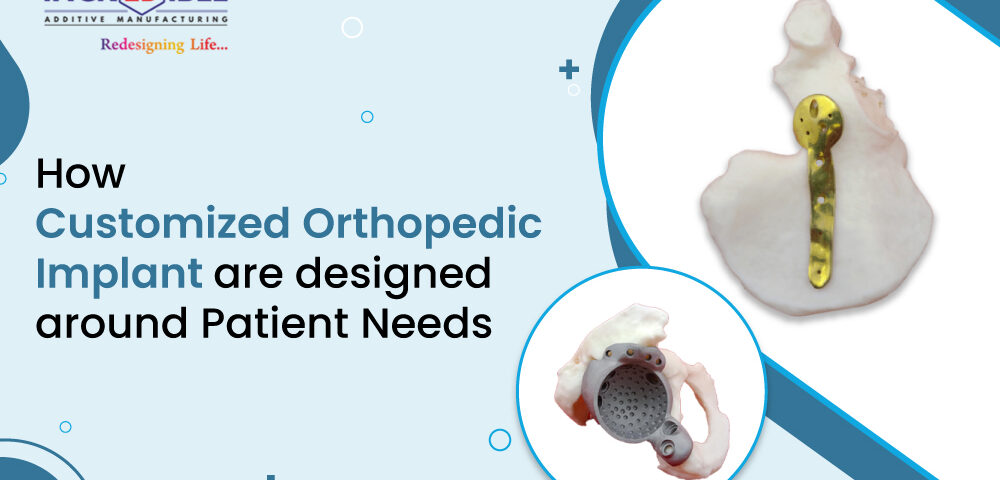 How Customized Orthopedic Implants Are Designed Around Patient Needs