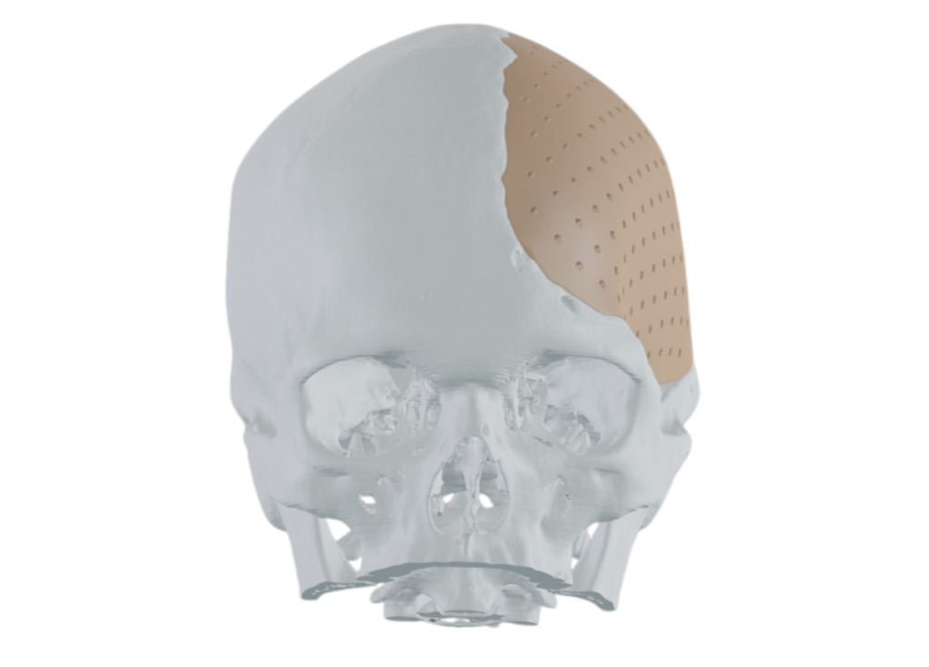 PEEK: A Lightweight, Strong, and Highly Biocompatible Option