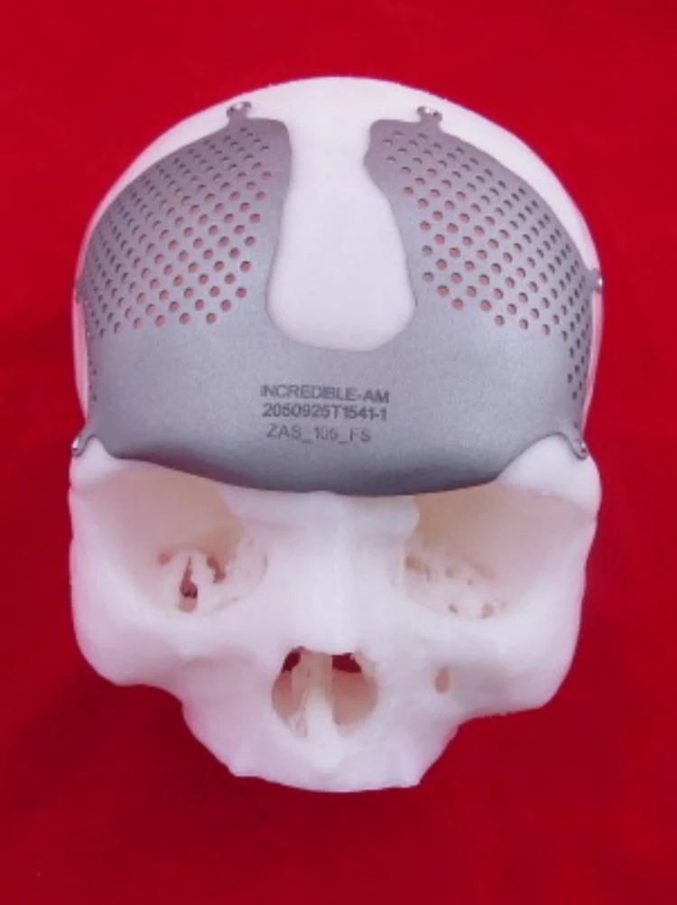cranial implants