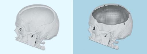 cranial implant