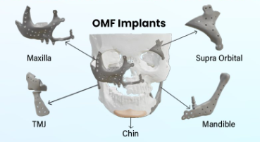 OMF Implant