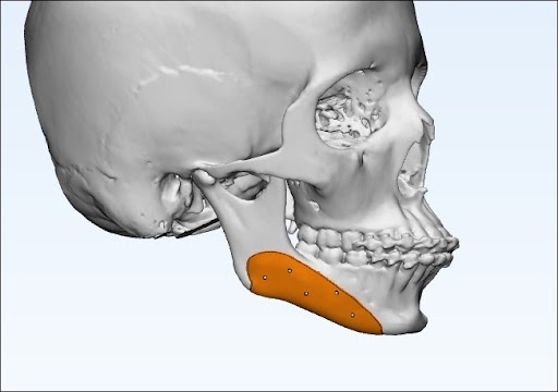 Customized Jaw Implants