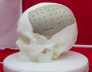 Cranial reconstruction