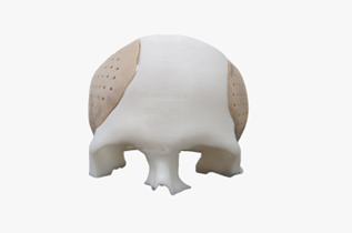 3D Printed Cranial Implants