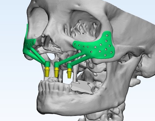 Customized Jaw Implants