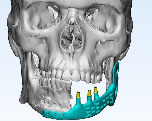 Customized Jaw Implants