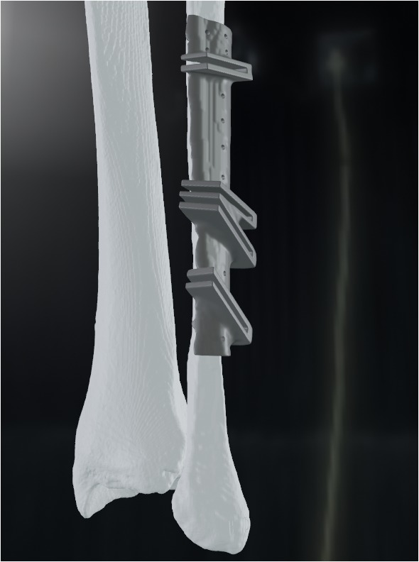 3D Printed Surgical Guides