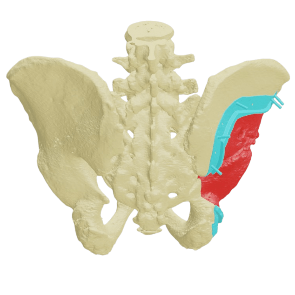 3D Printed Surgical Guides