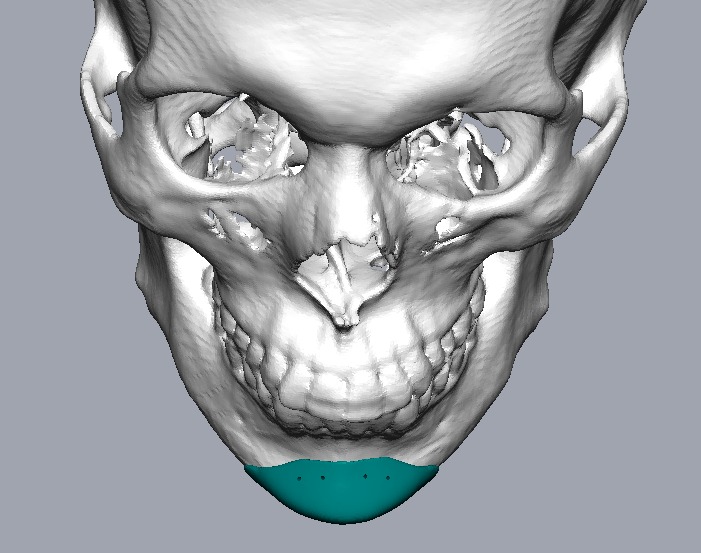 Chin Augmentation Implants