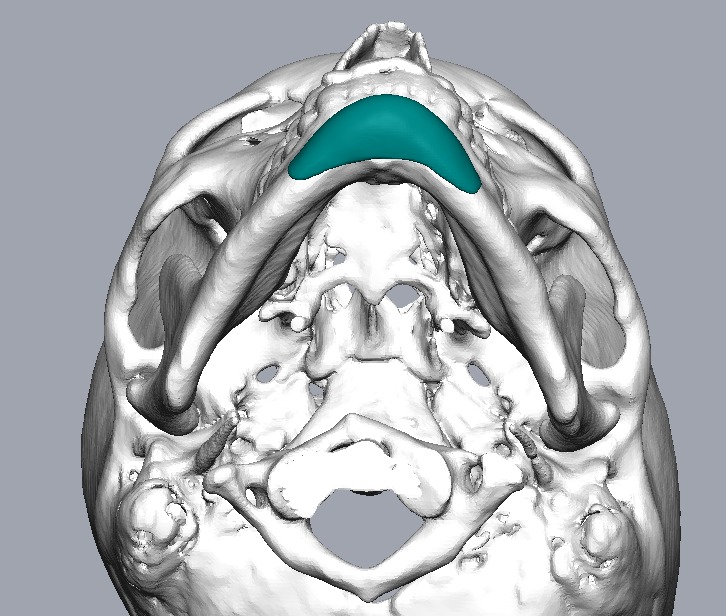 Chin Augmentation Implants