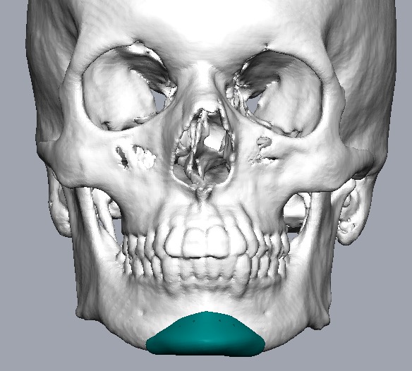 Chin Augmentation Implants