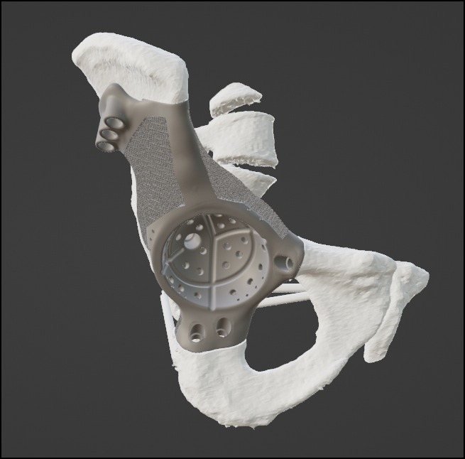 Hip Implants