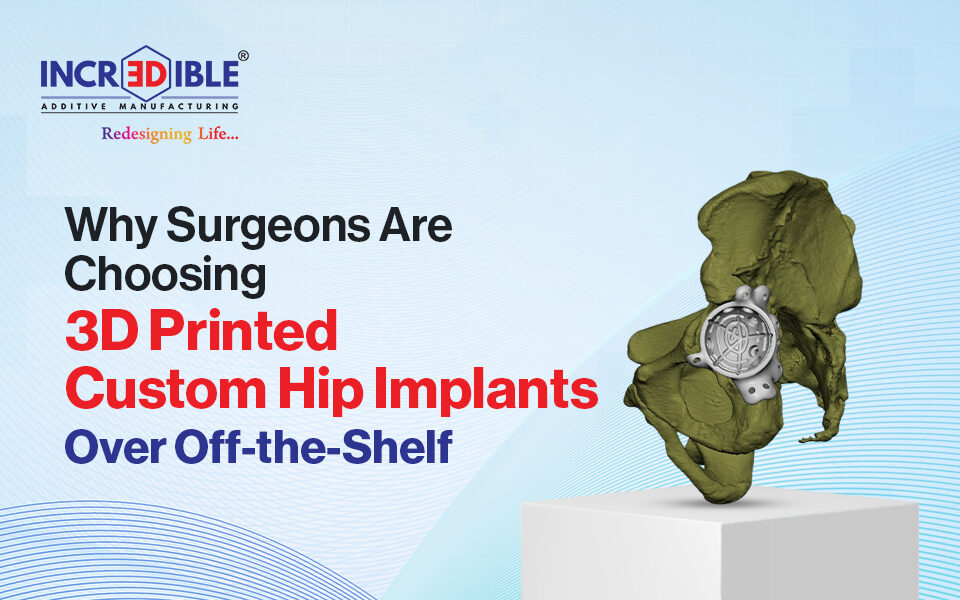 Why Surgeons Are Choosing 3D Printed Custom Hip Implants Over Off-the-Shelf