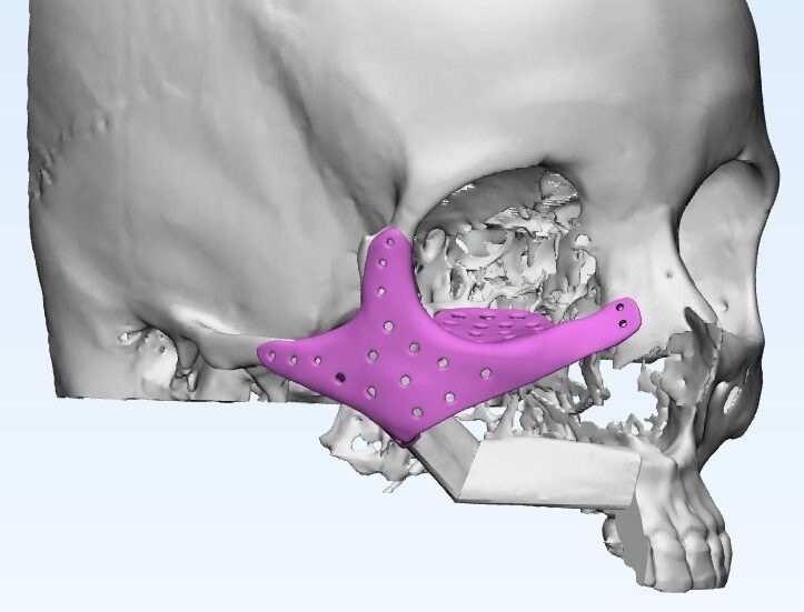 Titanium Zygoma Implants
