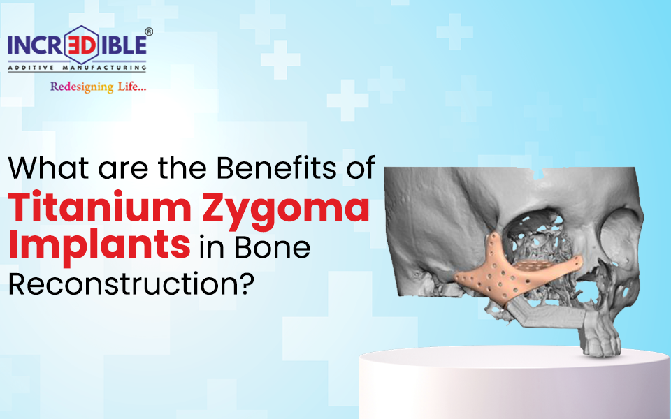 What are the Benefits of Titanium Zygoma Implants in Bone Reconstruction