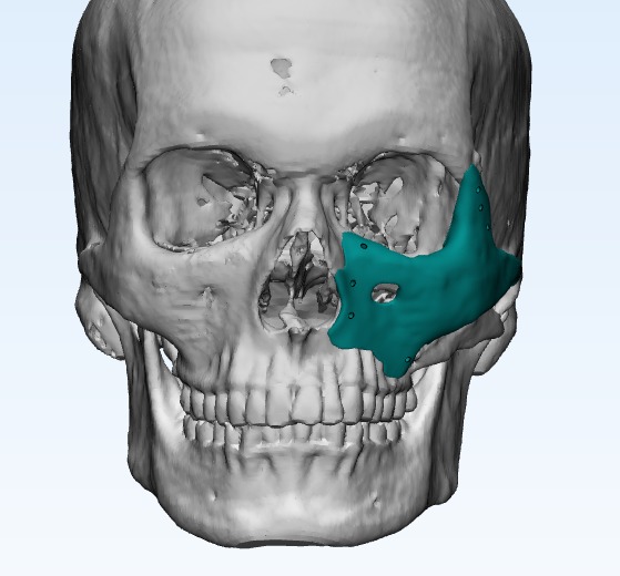 Titanium Zygoma Implants