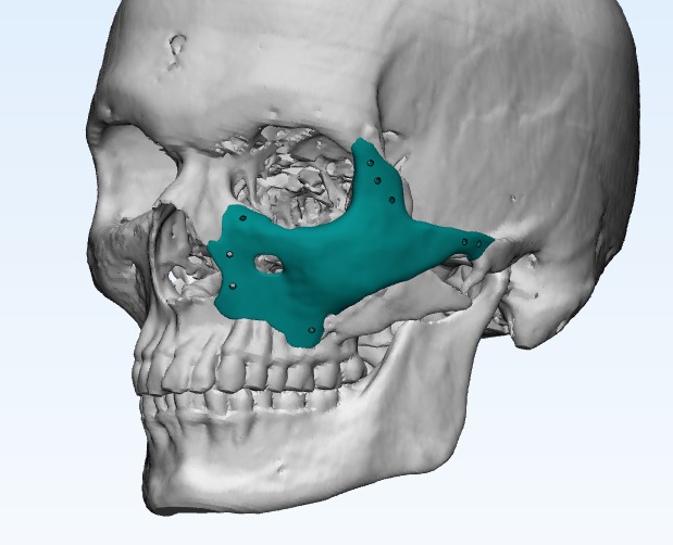 Titanium Zygoma Implants