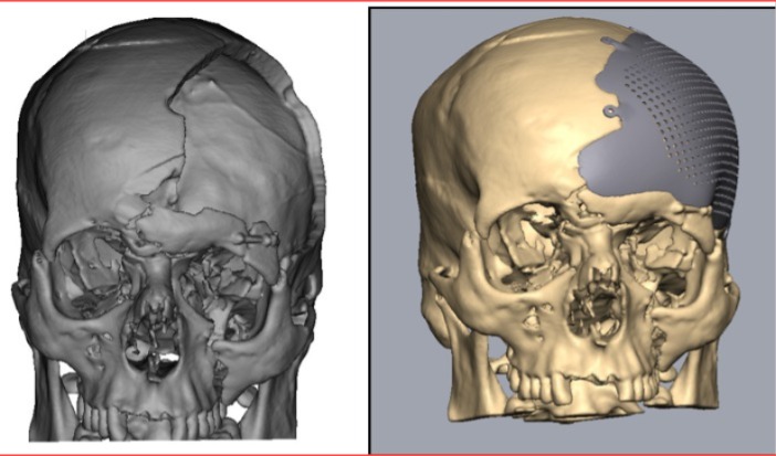 cranial implants