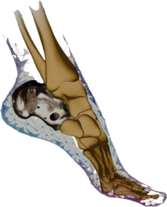 calcaneal implants