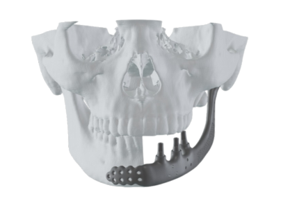 Mandible Implants