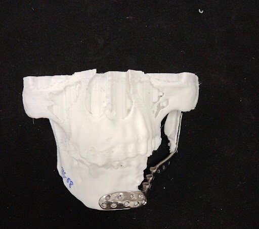 mandible implants