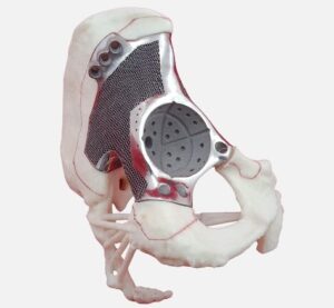 Orthopedic implant