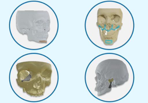 maxillofacial 3d printed implant