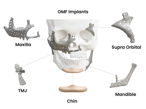 maxillofacial implant