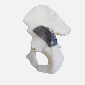 orthopedic implants
